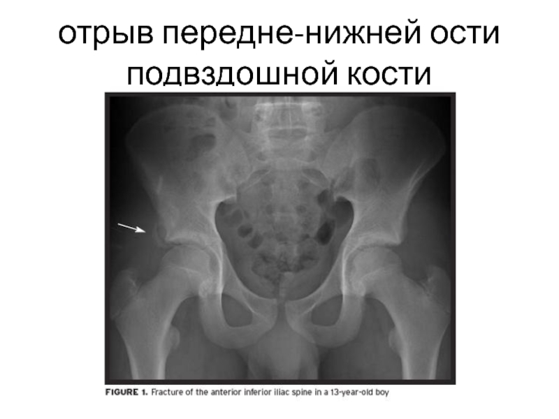 Передние ости подвздошных костей. Краевой перелом подвздошной кости. Перелом нижней передней ости подвздошной кости. Перелом тазовой кости рентген. Краевые переломы костей таза.
