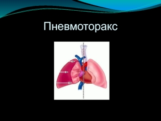 Пневмоторакс: клиника и диагностика