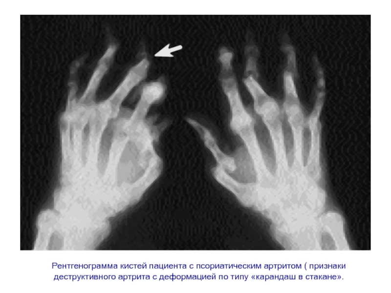 Ревматоидная кисть фото