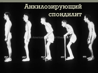 Анкилозирующий спондилит