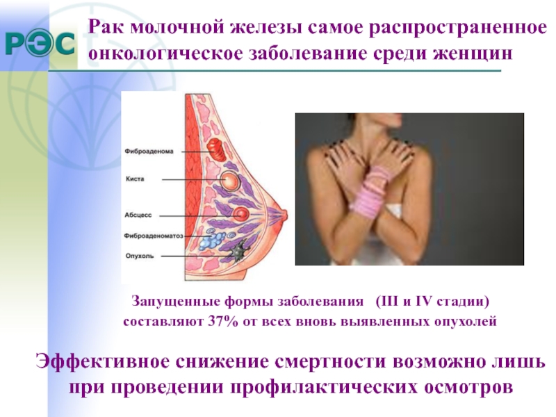 Рак молочной железы жизнь после. Онкология грудной железы. Молочная железа презентация. Болезни молочной железы. Злокачественные заболевания молочных желез.
