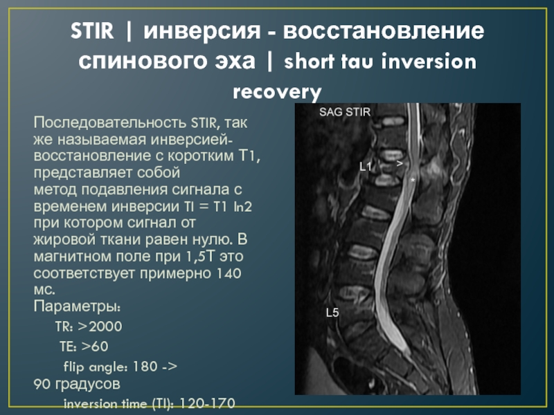 На т2 взвешенных изображениях при нативной магнитно резонансной томографии хорошо визуализируются