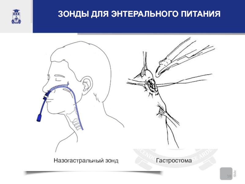 Зонд через нос