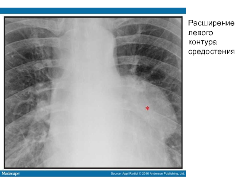 Расширение левой. Расширение тени средостения вправо. Расширение тени верхнего средостения рентген. Расширение тени средостения на рентгене. Расширение средостения на рентгене.