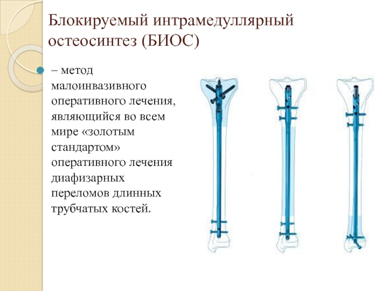 Интрамедуллярный остеосинтез плечевой кости