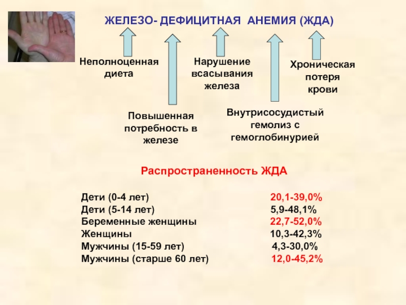 3 дефицитные анемии. Распространенность анемии. Распространенность железодефицитной анемии. Распространенность жда. Распространенность железодефицитной анемии в России.