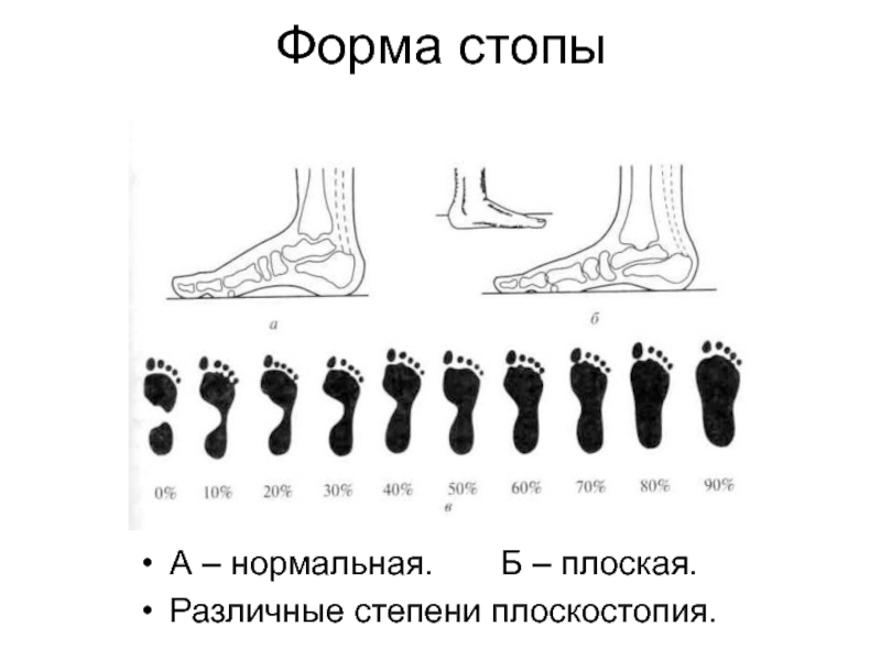 Степени стопы. Форма стопы. Степени плоскостопия. Плоскостопие по степеням. Стадии плоскостопия у подростков.