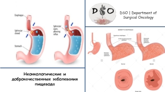 Неонкологические и доброкачественные заболевания пищевода