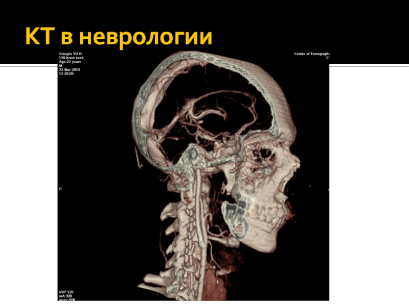 Кт в неврологии презентация