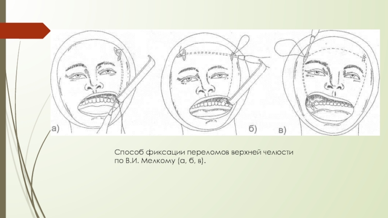 Методы временной и постоянной иммобилизации отломков челюстей презентация