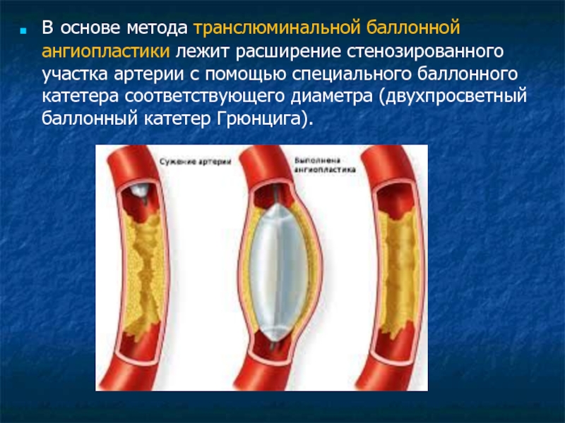 Транслюминальная ангиопластика