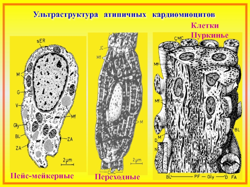 Атипичные кардиомиоциты рисунок