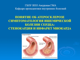 Атеросклероз. Ишемическая болезнь сердца. Стенокардия и инфаркт миокарда