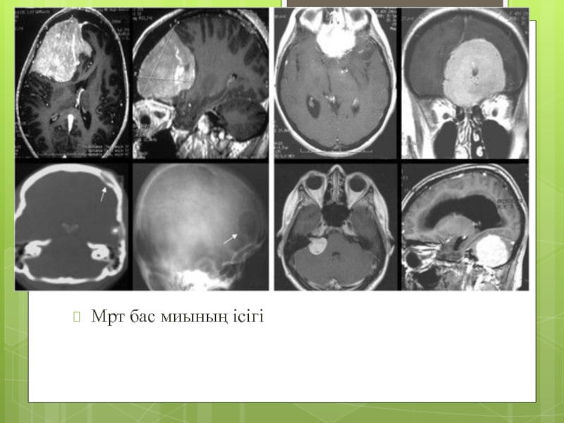 Опухоль головного мозга фото на мрт