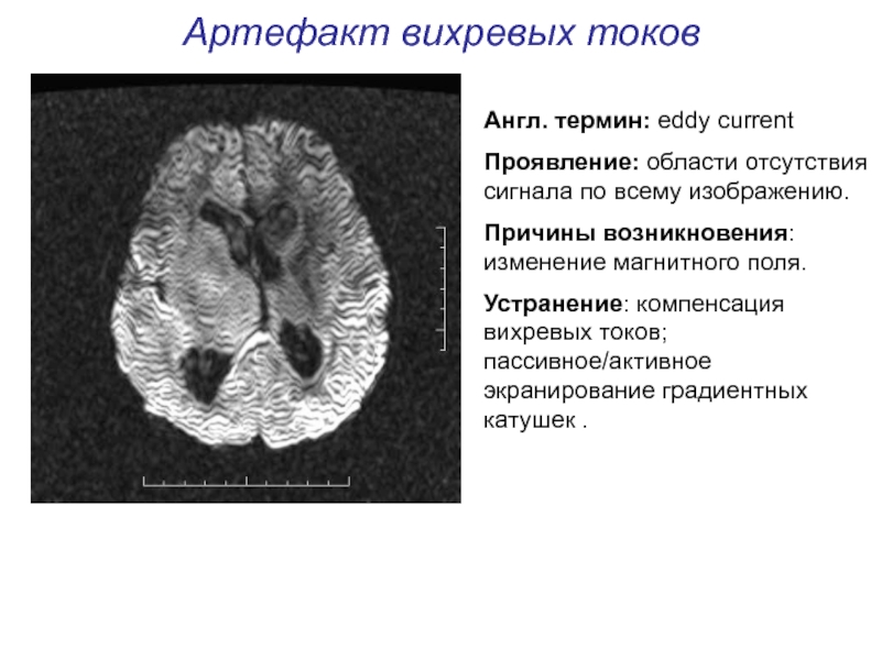 Артефакты мрт презентация