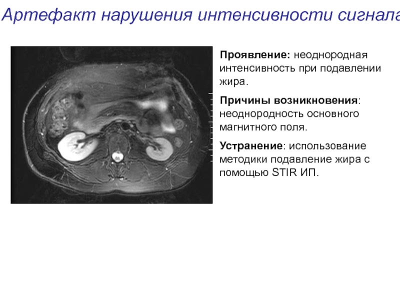 Артефакты мрт презентация