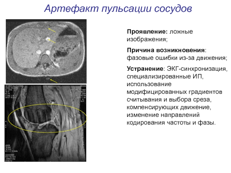 Артефакты мрт презентация