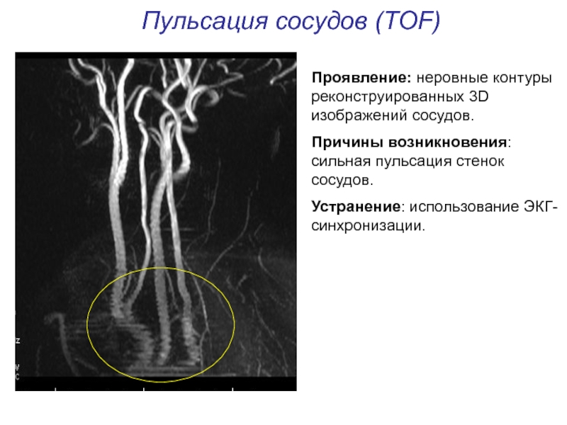 Артефакты мрт презентация