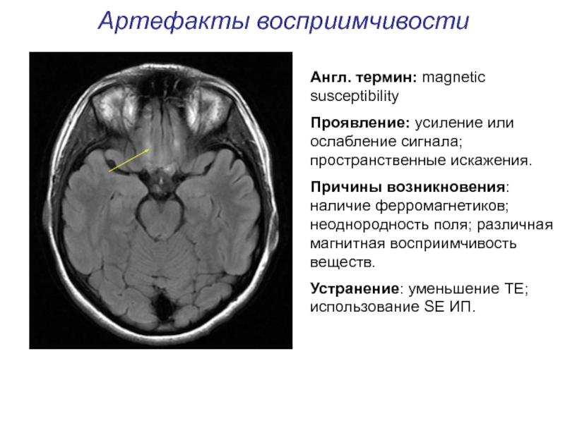 Артефакты мрт презентация