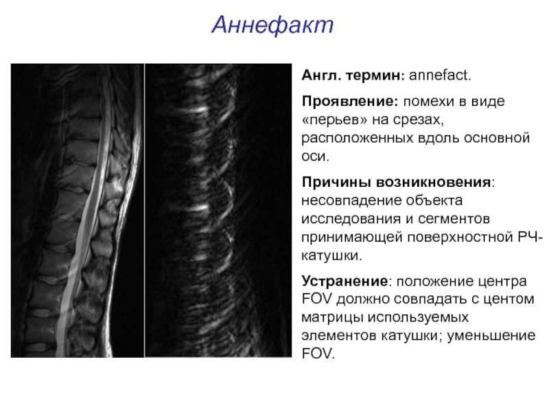 Артефакты мрт презентация