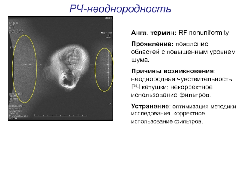 Артефакты мрт презентация