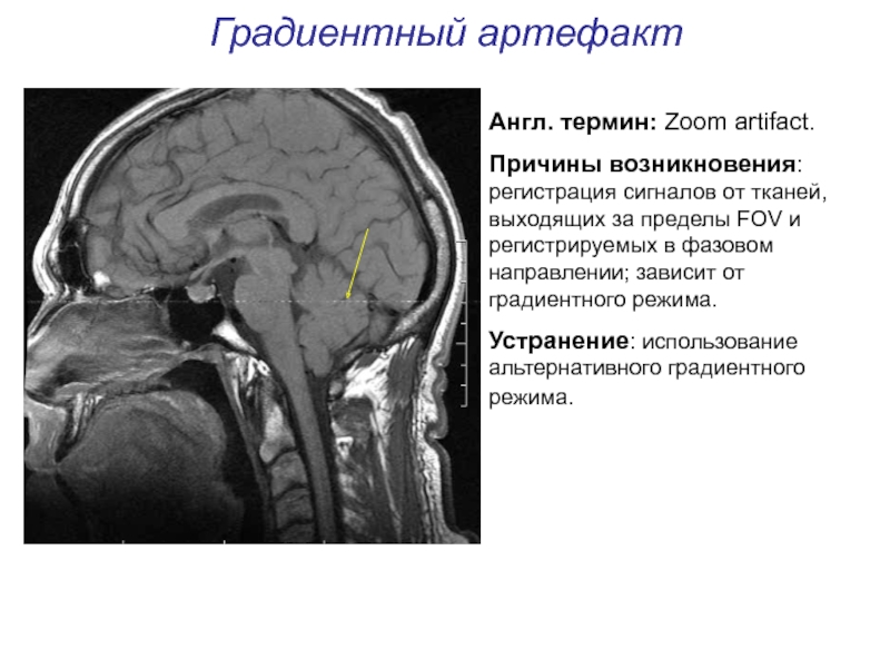 Артефакты мрт презентация