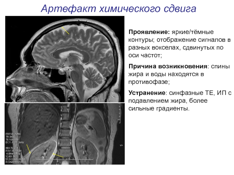 Артефакты мрт презентация