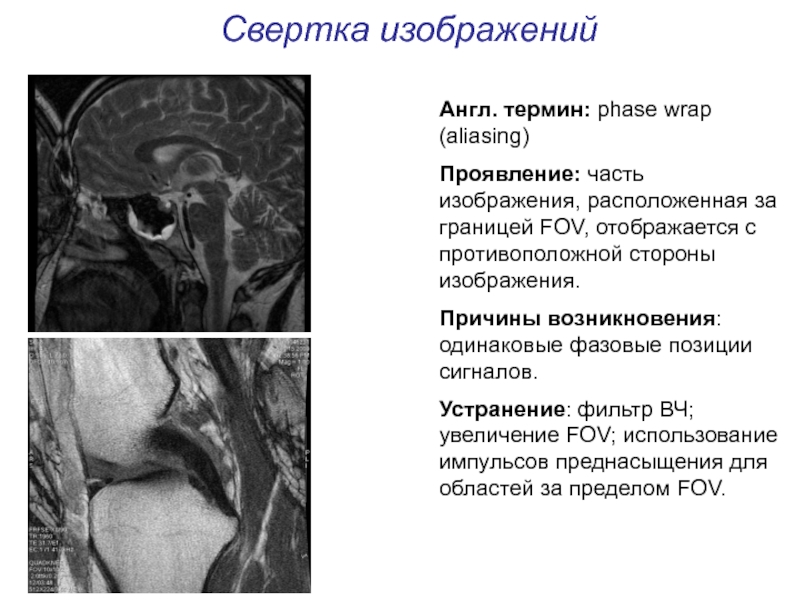 Артефакты мрт презентация