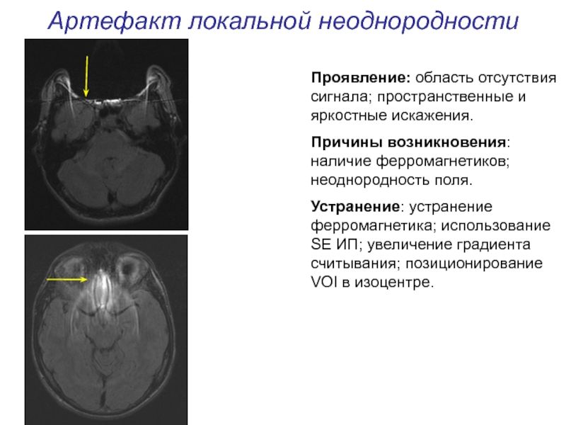 Артефакты мрт презентация