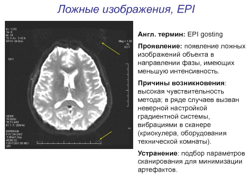 Артефакты мрт презентация