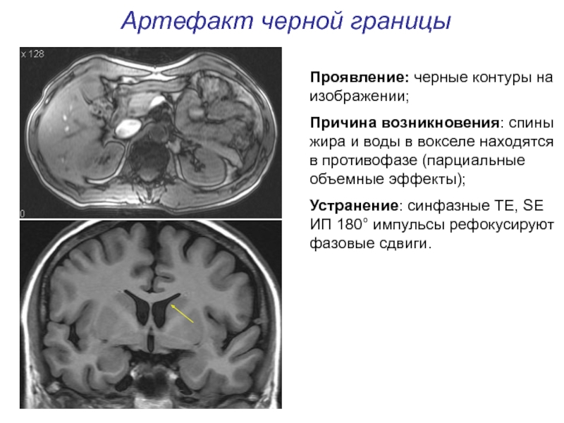 Артефакты мрт презентация