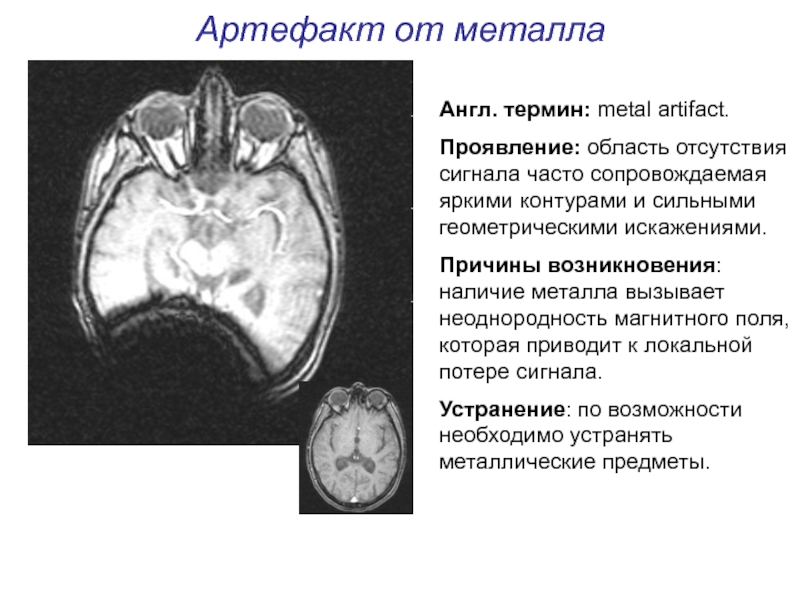 Артефакты мрт презентация