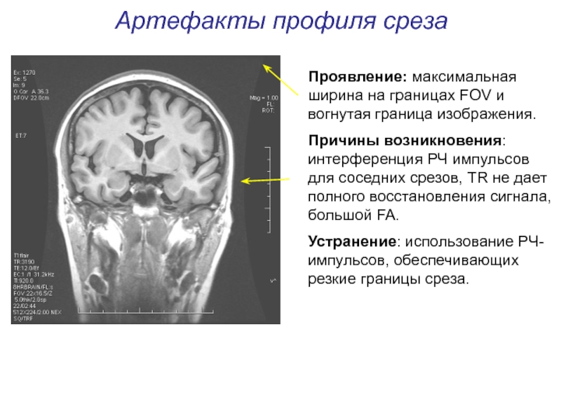 Артефакты мрт презентация