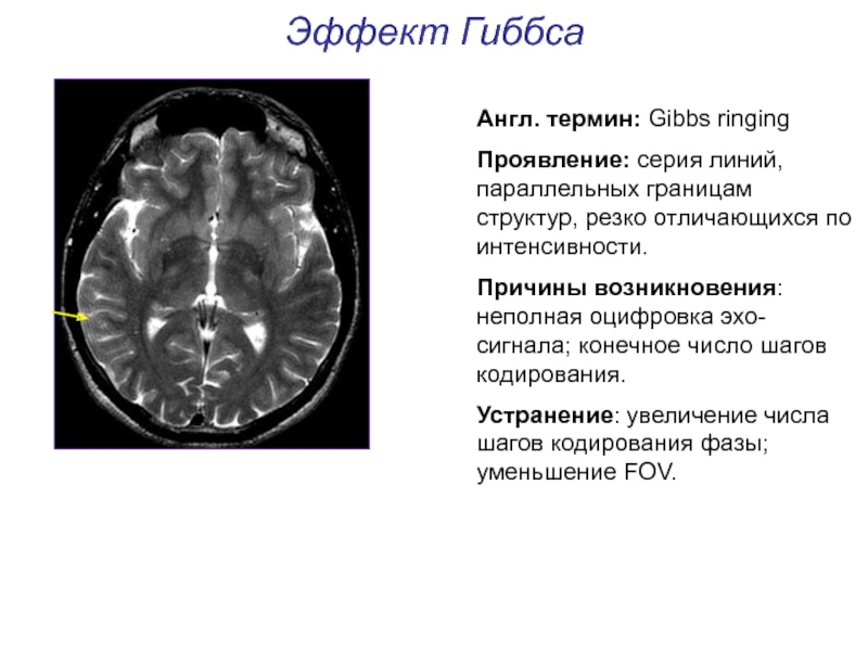 Артефакты мрт презентация