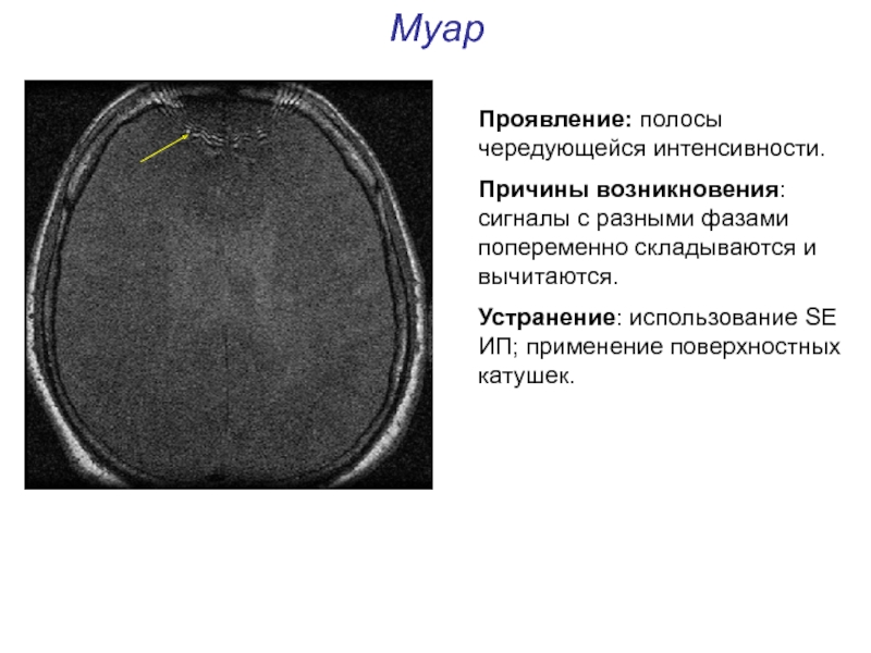 Артефакты мрт презентация