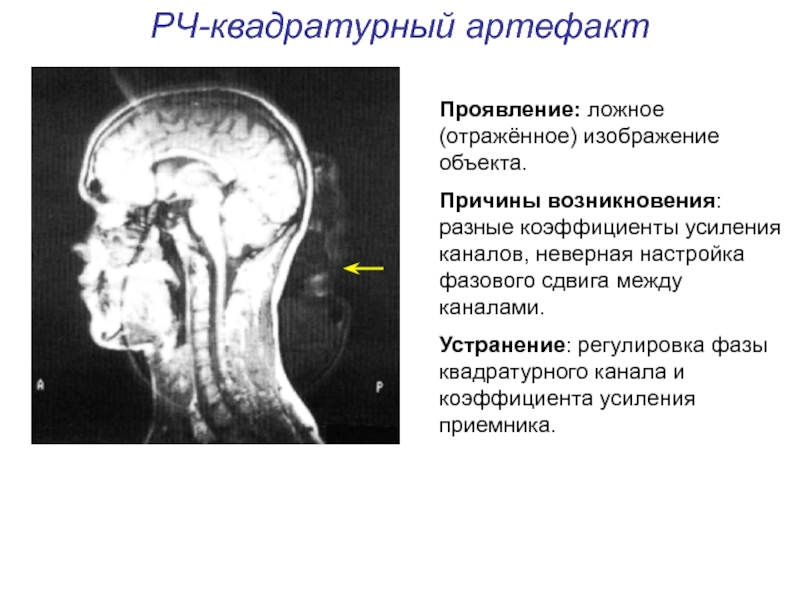 Артефакты мрт презентация