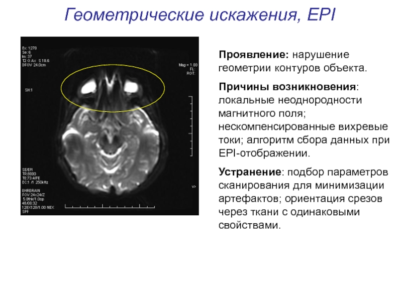 Артефакты мрт презентация