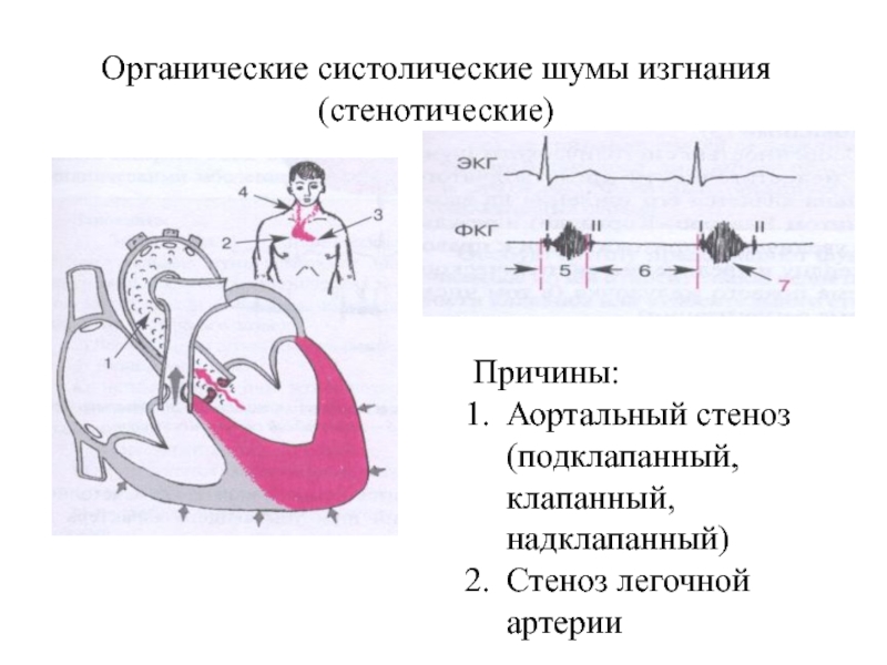 Аускультативная картина i тона сердца при стенозе устья аорты