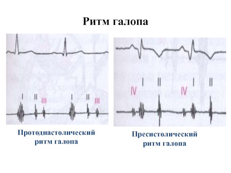 Ритм галопа при каком заболевании