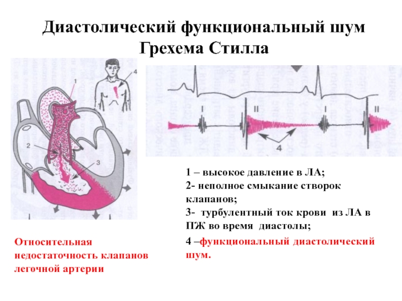 Недостаточность клапана легочной артерии