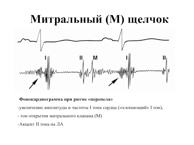 Ритм галопа сердце