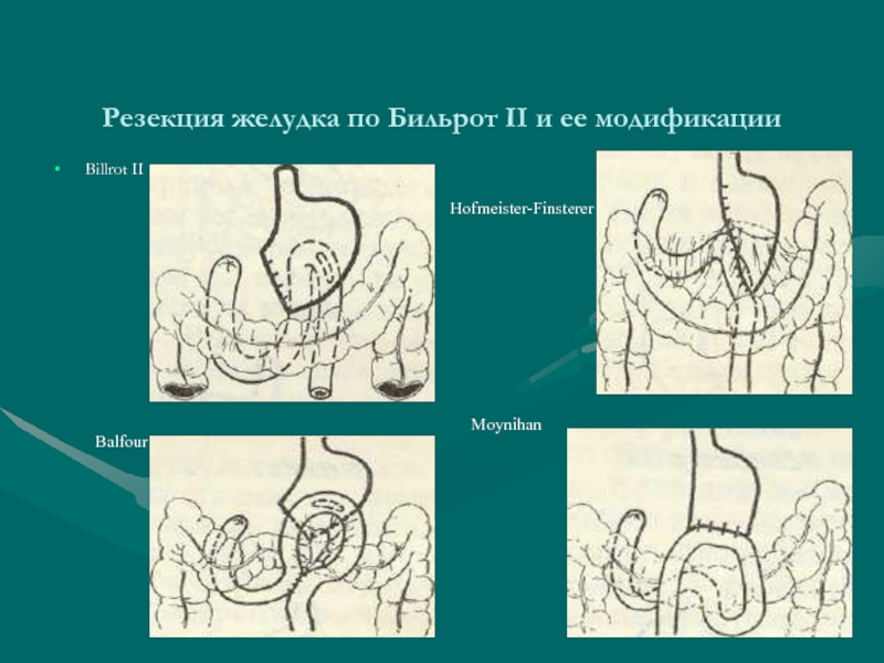 Резекция желудка по бальфуру схема