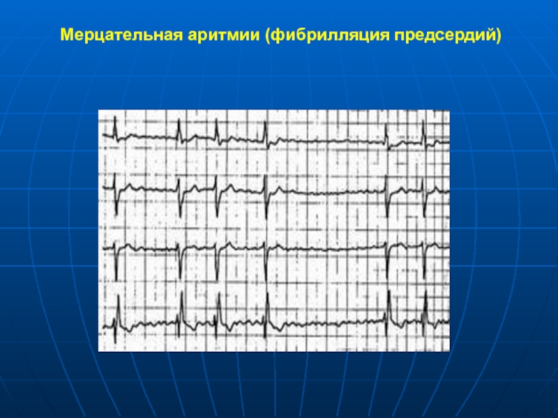 Синусовый ритм нарушение процесса реполяризации нижней стенки