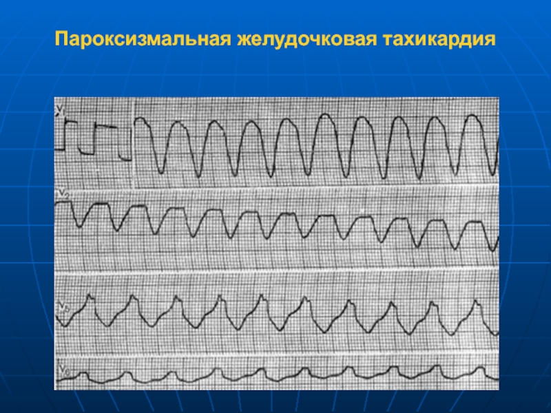 Желудочковые тахикардии презентация