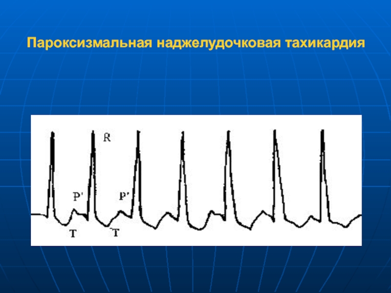 Наджелудочковая пароксизмальная тахикардия на экг фото