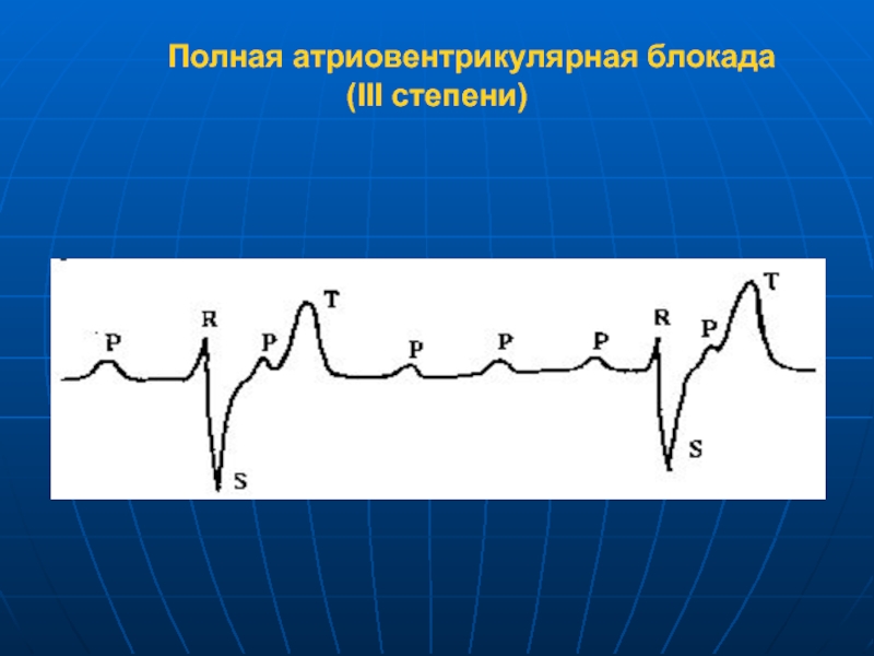 Ав блокада 3 степени на экг картинки