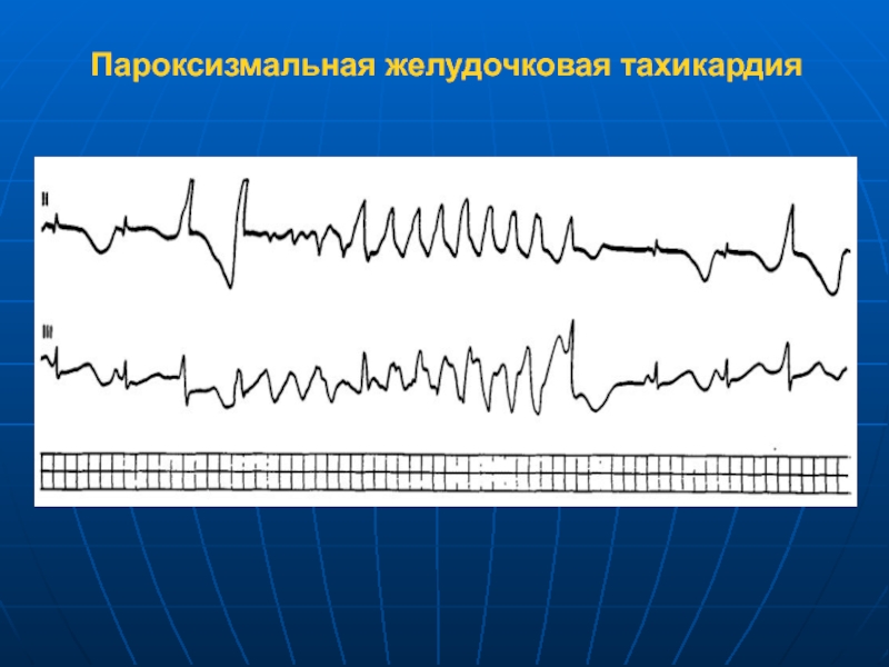 Тахикардия форум. Вентрикулярная пароксизмальная тахикардия. Пароксизмальная желудочкаваятахикардия. Пароксизмальная желудочковая тахикардия. Пароксизм неустойчивой желудочковой тахикардии на ЭКГ.