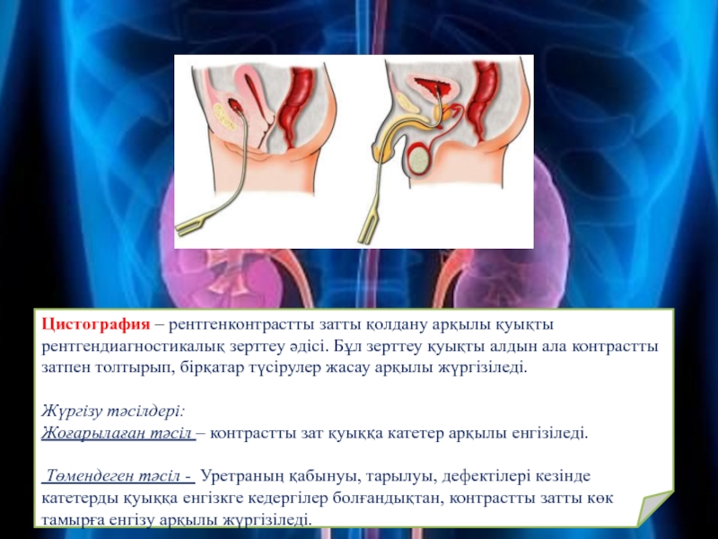 Цистография подготовка