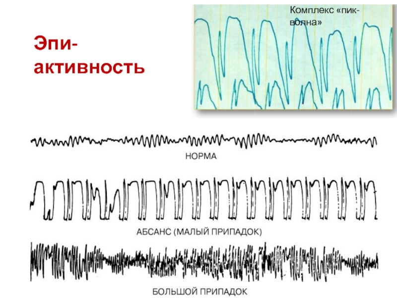 Комплекс медленных волн ээг. Комплексы пик волна на ЭЭГ. Пик волновая активность на ЭЭГ. ЭЭГ эпилепсия пик-волна. Комплекс острая медленная волна на ЭЭГ.