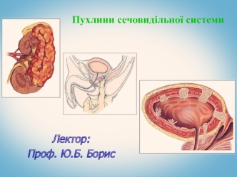 Пухлини сечовидільної системи